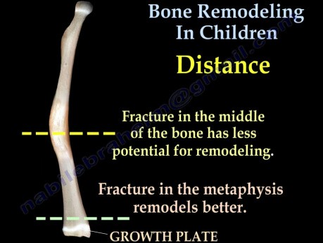 Złamania kości u dzieci i ich przebudowa