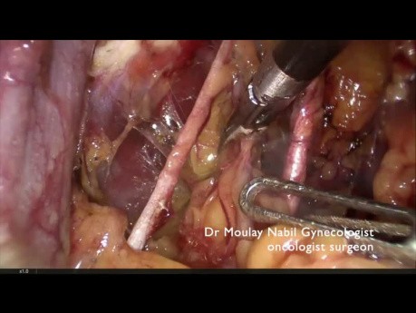 Leczenie raka endometrium