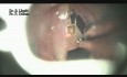 Obrzęk Reinkego - laserowa mikrochirurgia krtani