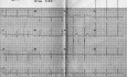 Kardiologiczny quiz 1 - pacjent ze szmerami serca - EKG, ECHO, leczenie