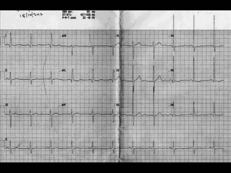 Kardiologiczny quiz 1 - pacjent ze szmerami serca - EKG, ECHO, leczenie