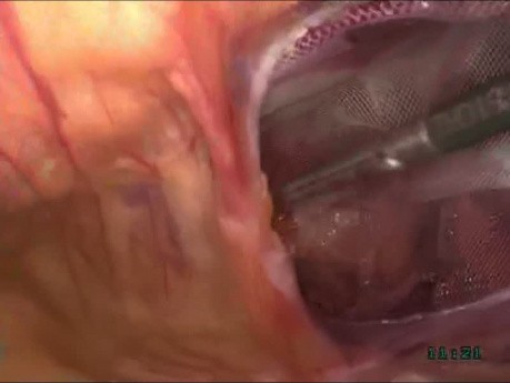 Leczenie laparoskopowe przepukliny pachwinowej