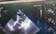 Przezprzedsionkowe zamknięcie ubytku przegrody międzykomorowej