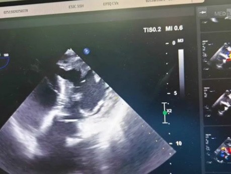 Przezprzedsionkowe zamknięcie ubytku przegrody międzykomorowej