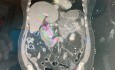 Cystrogastrostomia ze stentem