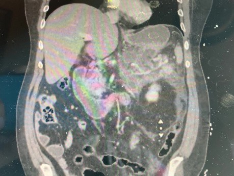 Cystrogastrostomia ze stentem