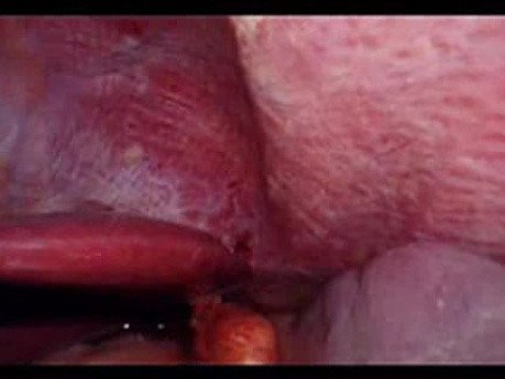 Perforacja okrężnicy z zapaleniem otrzewnej - laparoskopia (38 z 46)