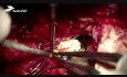 Dodatkowe zabezpieczenie tętniaka tętnicy środkowej mózgu matrycą TachoSil