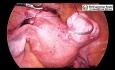 Laparoskopowa miomektomia w przypadku mięśniaka więzadła szerokiego macicy