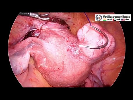 Laparoskopowa miomektomia w przypadku mięśniaka więzadła szerokiego macicy