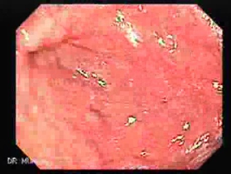 Żylaki żołądka - endoskopowa ablacja klejem cyjanoakrylowym (19 z 18)
