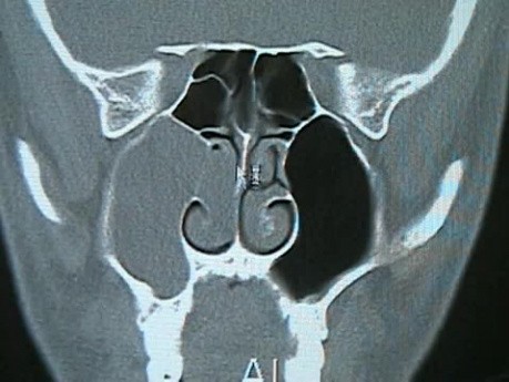 Endoskopowe usunięcie polipa choanalnego