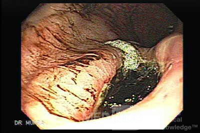 Rak żołądka - ocena głębokiego wrzodu, część 2