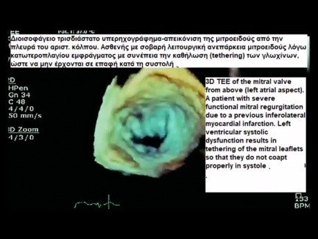 Czynnościowa niedomykalność mitralna - ECHO 2D, 3D przezprzełykowe
