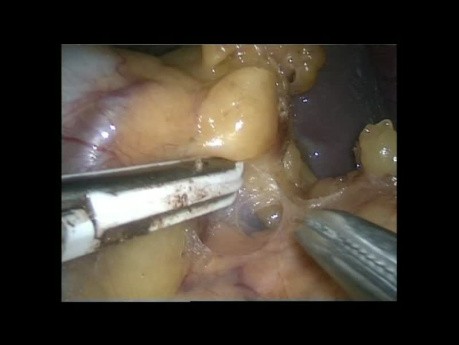 Splenektomia laparoskopowa z powodu licznych tętniaków tętnicy śledzionowej