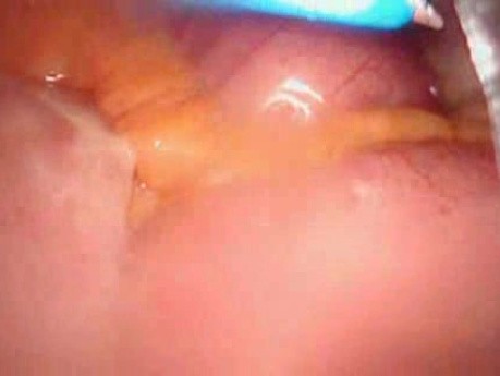 Perforacja okrężnicy z zapaleniem otrzewnej - laparoskopia (25 z 46)