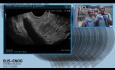 Ultrasonografia endoskopowa (EUS) z biopsją cienkoigłową (FNA)