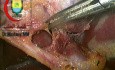 "Caterpillar hump" prawej tętnicy wątrobowej