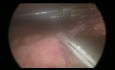 Perforacja jelita cienkiego wyniku urazu jamy brzusznej – dostęp laparoskopowy