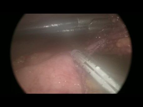 Perforacja jelita cienkiego wyniku urazu jamy brzusznej – dostęp laparoskopowy