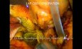 Laparoskopowa eksploracja przewodu żółciowego wspólnego