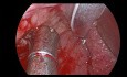 Hemostaza krwawienia po tonsilektomii