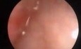 Krwawienie z pochwy spowodowane polipem endometrium