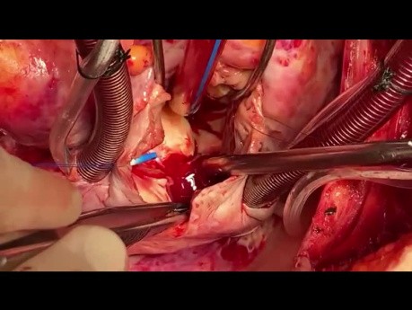 Pacjent z guzem lewej komory i jednoczesnym uszkodzeniem zastawki mitralnej i aortalnej