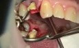 Natychmiastowa implantacja po ekstrakcji zęba
