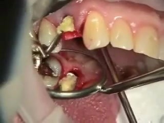 Natychmiastowa implantacja po ekstrakcji zęba