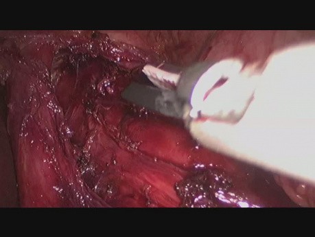 Laparoskopowe leczenie achalazji - kardiomiotomia Hellera z fundoplikacją Dor 