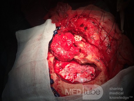 Usunięcie oponiaka - OZO (orbitozygomatic osteotomy)