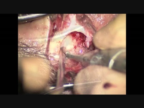 Wszczepienie implantu systemu Bonebridge