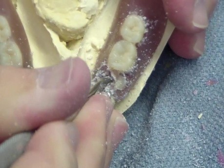 Odrzuty Laboratorium Stomatologicznego - Ząb w ruchu - Część 1/2 : Naprawa protezy