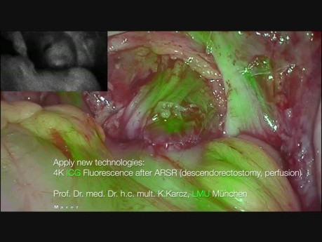 Przednia resekcja odbytnicy z zastosowaniem ICG po ARR (Descendorectostomy)