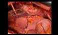 Transwersoktomia całkowita z segmentową resekcją żołądka, atypową hepatektomią 2-3 oraz częściową resekcją przepony i osiedzia z powodu miejscowo zaawansowanego gruczolakoraka okrężnicy poprzecznej