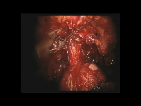 Prostatektomia robotowa HD - DaVinci - część 2
