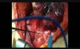Śródoperacyjne monitorowanie  nerwu krtaniowego wstecznego podczas tyroidektomii za pomocą NIM-Response 3.0
