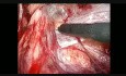 Laparoskopowa plastyka przepukliny pachwinowej- krok 4: preparowanie strony prawej