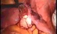 Leczenie laparoskopowe torbieli okołojajnikowej