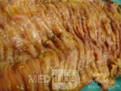 Toxic Dilatation of the Colon Superimposed pseudomembranous colitis involving the right colon (15 of 17)