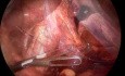 Laparoskopowa operacja przepukliny rozworu przełykowego