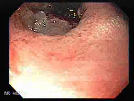 Rak Płaskonabłonkowy Dystalnej Części Przełyku - Gastroskopowy Obraz Retrofleksyjny