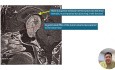 Dostęp transplanum w leczeniu litego olbrzymiego gruczolaka przysadki mózgowej