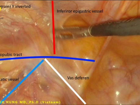 Nowy koncept anatomiczny laparoskopowej naprawy przepukliny pachwinowej