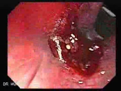 Gruczolaki cewkowo - kosmkowe odbytnicy - endoskopia (7 z 35)