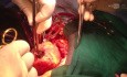 Demonstration of Anteroir VSD