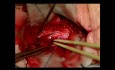 Hemangioblastoma (naczyniak krwionośny zarodkowy) rdzenia kręgowego na wysokości kręgu C2