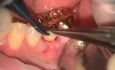 Funkcjonalny przeszczep dziąsła w okolicy policzkowej zęba 36