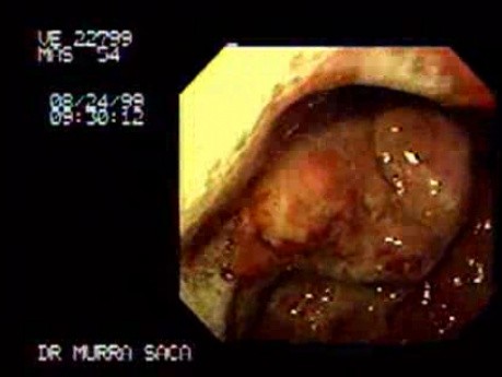 Zaawansowany rak trzonu żołądka - endoskopia